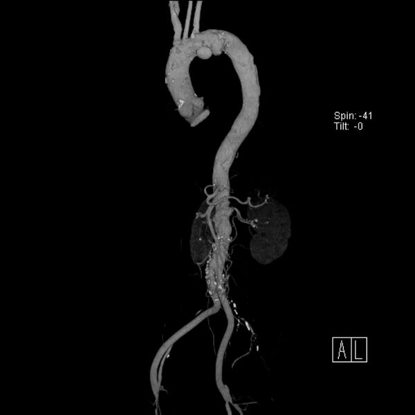 File:Aortic arch saccular aneurysm (Radiopaedia 19430-19457 A 3).jpg