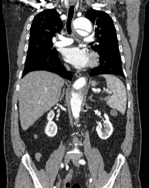 File:Aortic dissection (Radiopaedia 44411-48061 A 29).jpg