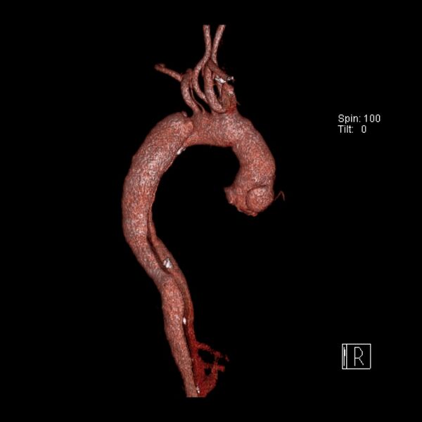 File:Aortic dissection - De Bakey type III - Stanford B (Radiopaedia 21903-21882 3D C+ arterial phase 6).jpg