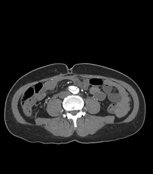 File:Aortic dissection with renal ischemia (Radiopaedia 76573-88338 A 84).jpg
