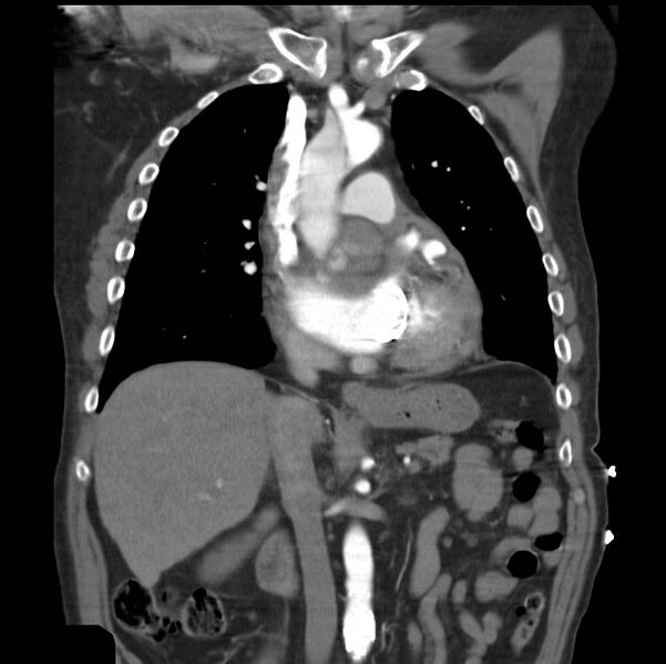 File:Aortic dissection with rupture into pericardium (Radiopaedia 12384-12647 B 18).jpg