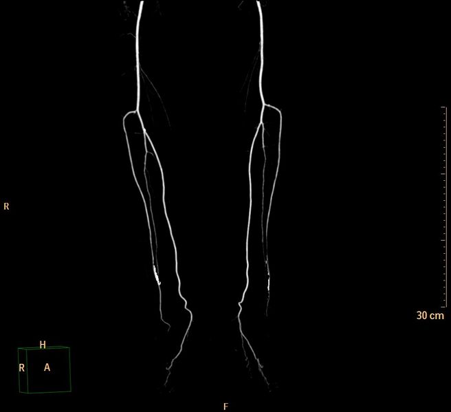 File:Aortoiliac occlusive disease (Radiopaedia 31376-32161 3D-VR Leg arteries 3).jpg