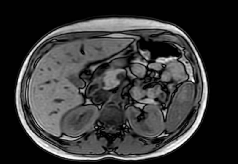 File:Appendicitis in gravida (MRI) (Radiopaedia 89433-106395 D 18).jpg