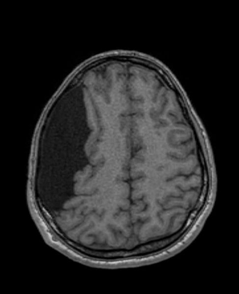 File:Arachnoid cyst- extremely large (Radiopaedia 68741-78451 Axial T1 58).jpg