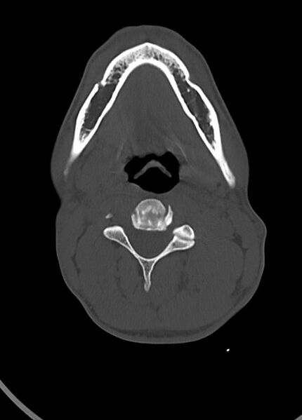 File:Arrow injury to the head (Radiopaedia 75266-86388 Axial bone window 17).jpg