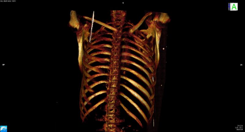 File:Arrow injury to the neck (Radiopaedia 75225-86323 3D bone 40).jpg