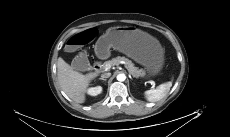 File:Arterial occlusive mesenteric ischemia (Radiopaedia 84641-100060 A 45).jpg