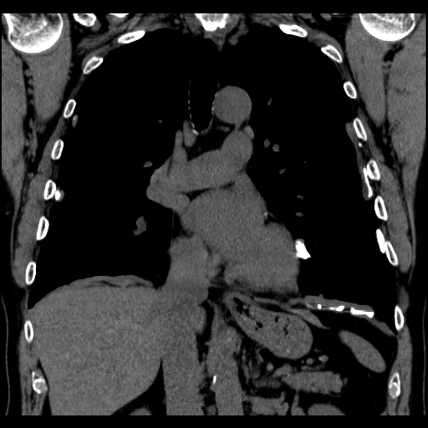 Asbestos-related pleural plaques (Radiopaedia 39069-41255 Coronal non-contrast 46).jpg
