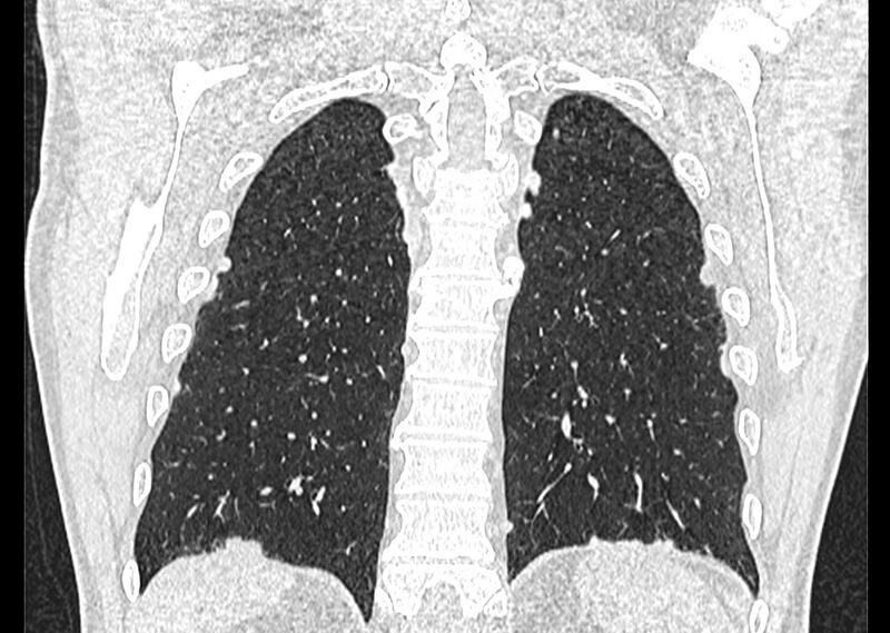 File:Asbestos pleural placques (Radiopaedia 57905-64872 Coronal lung window 230).jpg