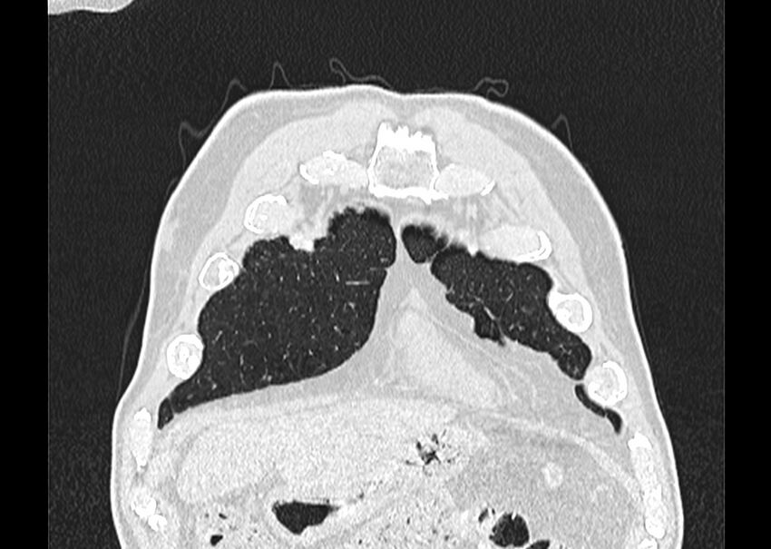 Asbestos pleural placques (Radiopaedia 57905-64872 Coronal lung window 24).jpg
