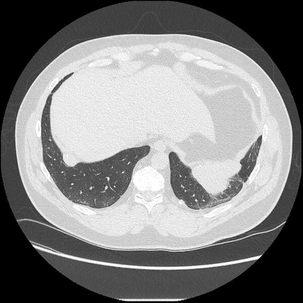 File:Asbestosis (Radiopaedia 45002-48961 Axial lung window 40).jpg