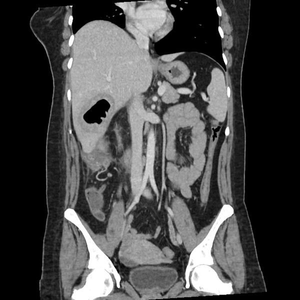File:Ascending retrocecal appendicitis with liver abscesses (Radiopaedia 60066-67615 C 20).jpg