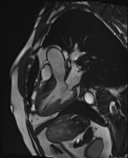 File:Asymmetric septal hypertrophic cardiomyopathy - systolic anterior motion of mitral leaflet (Radiopaedia 72795-83445 B 2).jpg