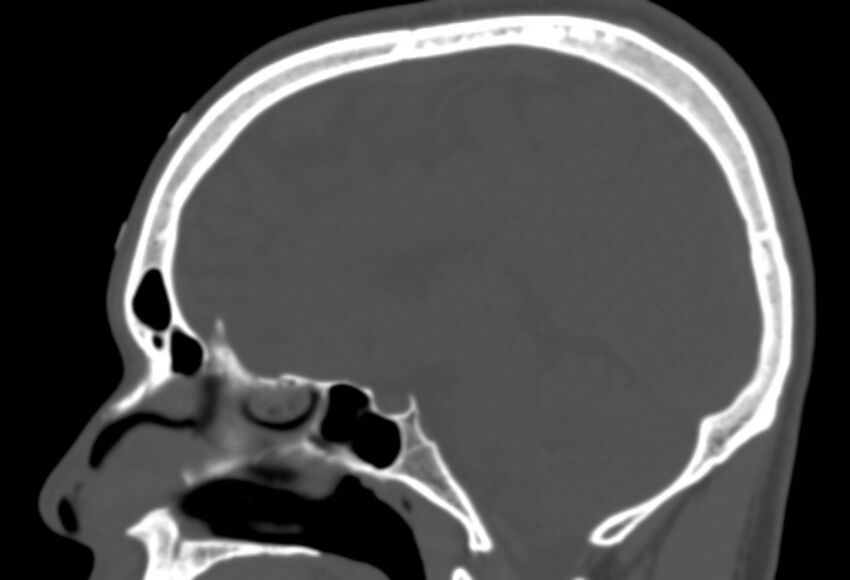 Asymptomatic occipital spur (Radiopaedia 87753-104201 Sagittal bone window 146).jpg