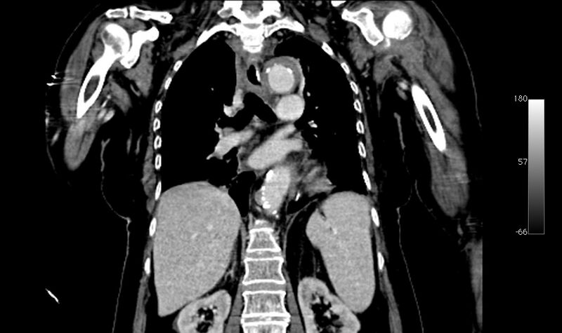 File:Atypical dissection of the thoracic aorta (Radiopaedia 10975-78320 B 25).jpg