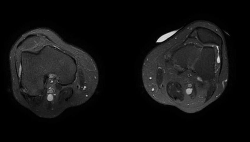 Atypical lipomatous tumor - thigh (Radiopaedia 68975-78734 Axial T2 fat sat 12).jpg