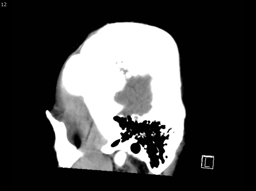 Atypical meningioma - intraosseous (Radiopaedia 64915-73867 C 10).jpg