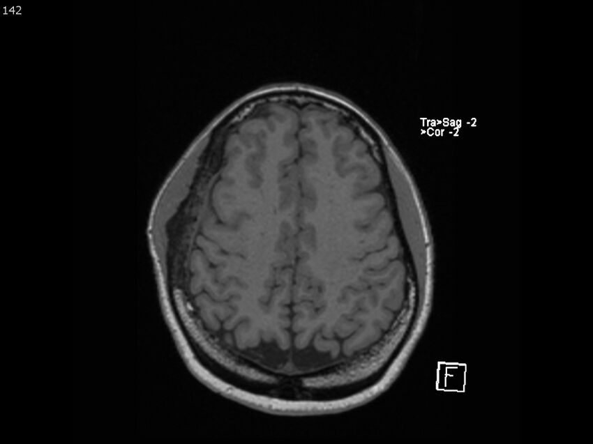 Atypical meningioma - intraosseous (Radiopaedia 64915-74572 Axial T1 142).jpg