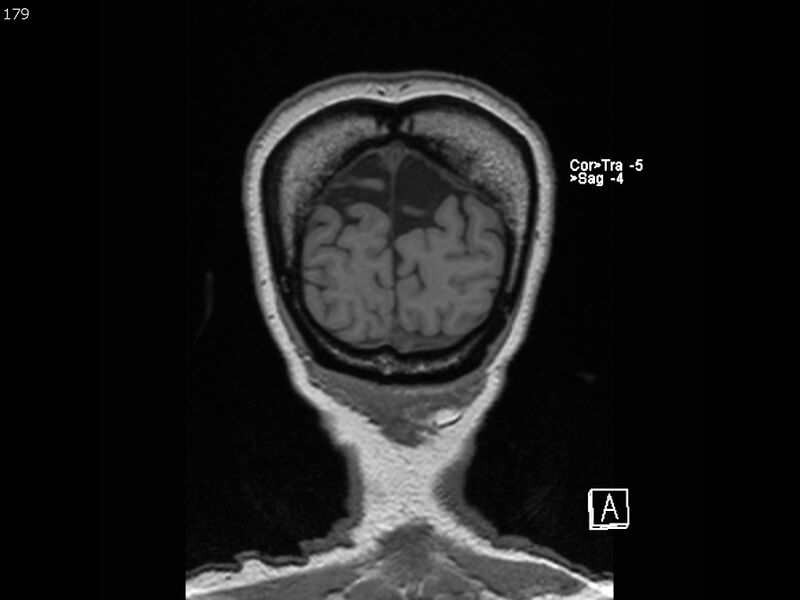 File:Atypical meningioma - intraosseous (Radiopaedia 64915-74572 Coronal T1 179).jpg
