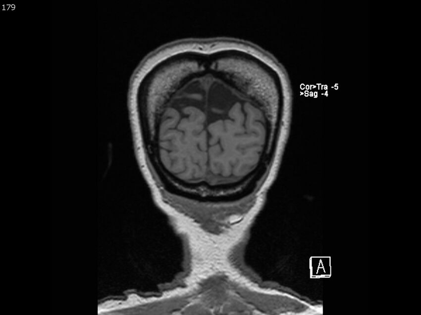 Atypical meningioma - intraosseous (Radiopaedia 64915-74572 Coronal T1 179).jpg