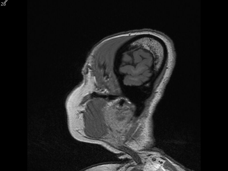 File:Atypical meningioma - intraosseous (Radiopaedia 64915-74572 Sagittal T1 28).jpg