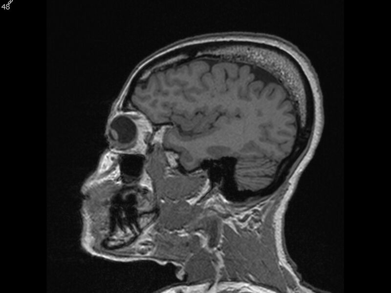 File:Atypical meningioma - intraosseous (Radiopaedia 64915-74572 Sagittal T1 48).jpg