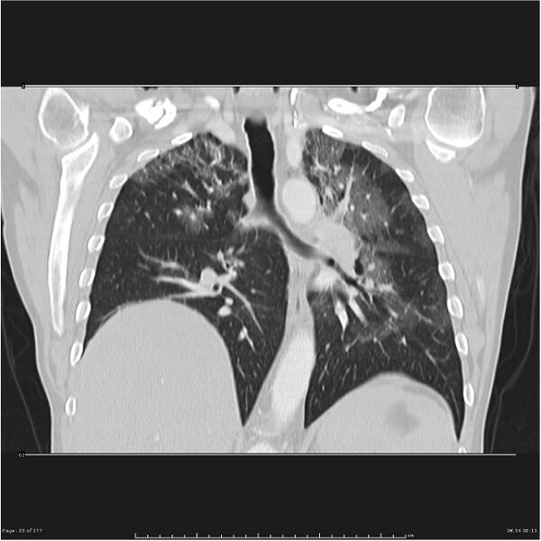 File:Atypical pneumonia - Q fever (Radiopaedia 21993-21989 C 26).jpg