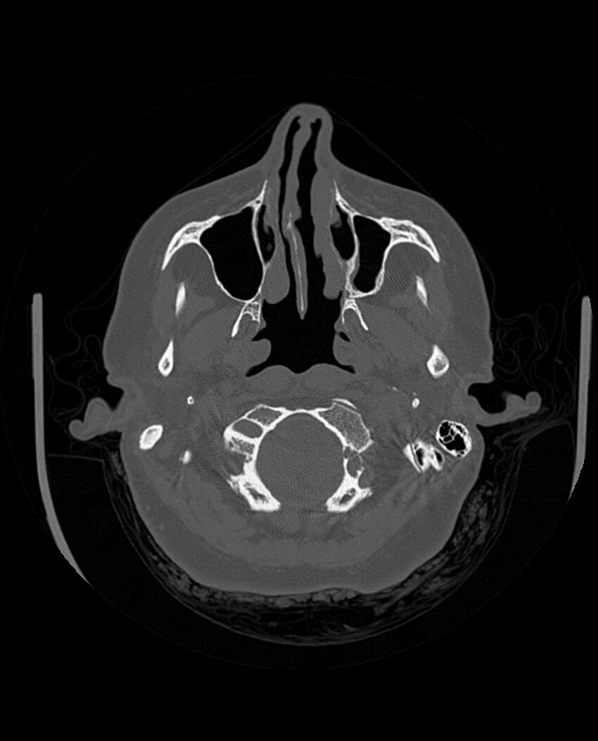 Automastoidectomy with labyrinthine fistula (Radiopaedia 84143-99411 Axial non-contrast 56).jpg