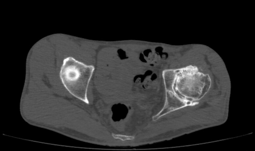 Avascular necrosis of the left hip (Radiopaedia 75068-86125 Axial bone window 32).jpg