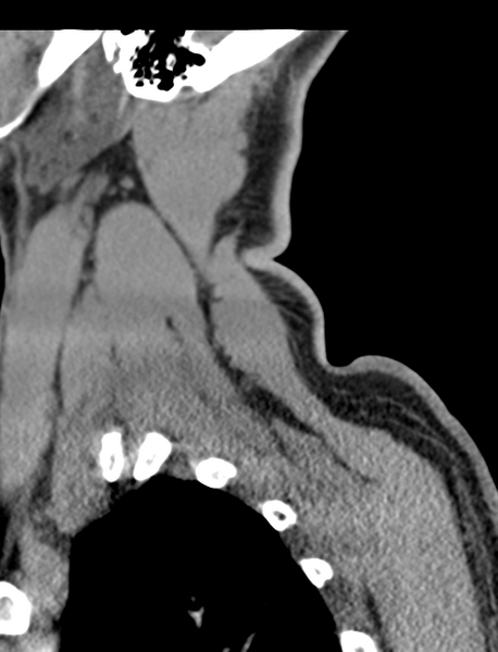 File:Axis peg fracture (type 3) and atlas lateral mass (type 4) fracture (Radiopaedia 37474-39324 D 69).png