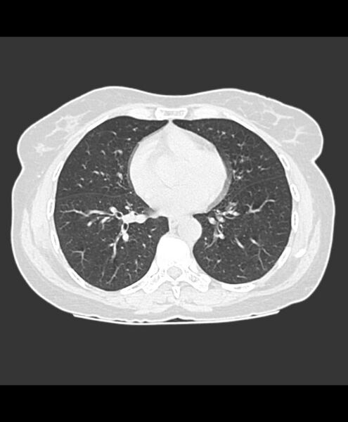 File:Azygos fissure and azygos lobe (Radiopaedia 41841-44832 Axial lung window 9).jpg