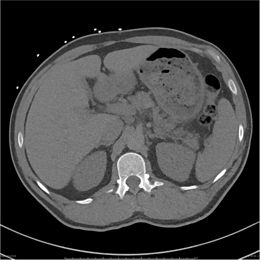 Azygos venous system anatomy (CT pulmonary angiography) (Radiopaedia 25928-26077 Axial C+ CTPA 95).jpg