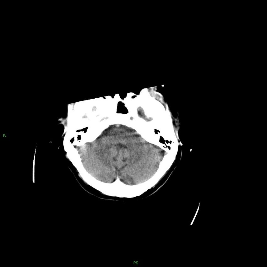 Basal ganglia hemorrhage (Radiopaedia 58349-65472 Axial non-contrast 45).jpg