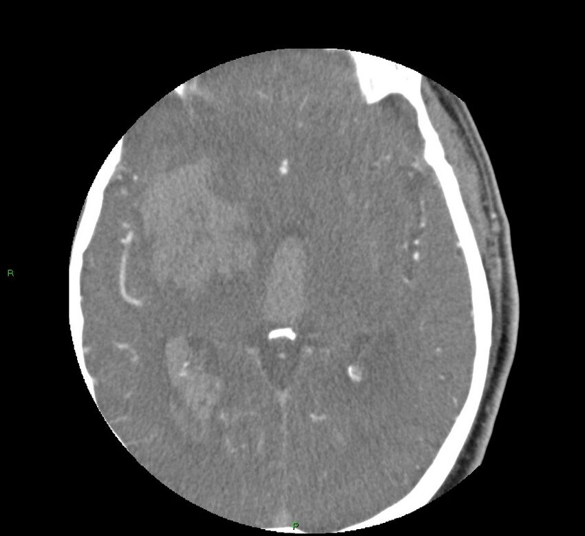 Basal ganglia hemorrhage (Radiopaedia 58763-65985 D 93).jpg