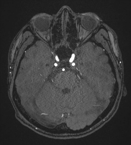 File:Basal ganglia subacute infarct (Radiopaedia 80201-93521 Axial MRA 33).png