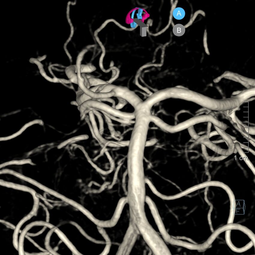 Basilar artery perforator aneurysm (Radiopaedia 82455-97734 3D view left VA 112).jpg