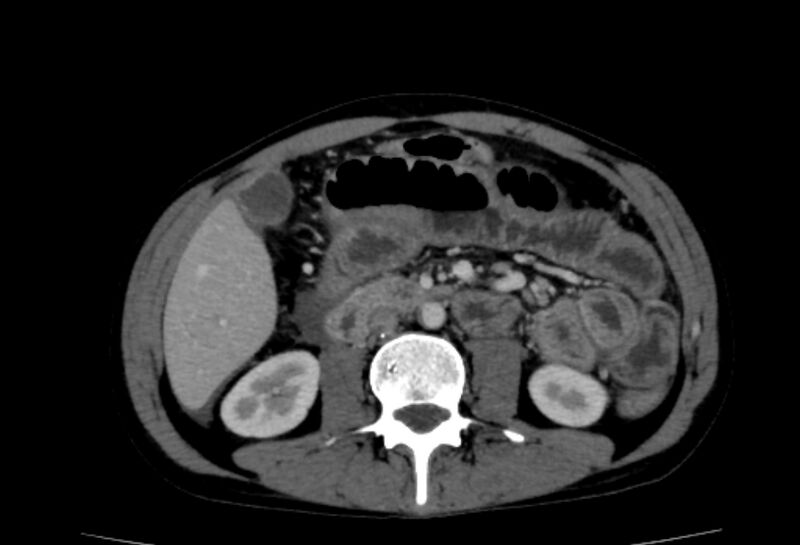File:Behçet's disease- abdominal vasculitis (Radiopaedia 55955-62570 A 38).jpg