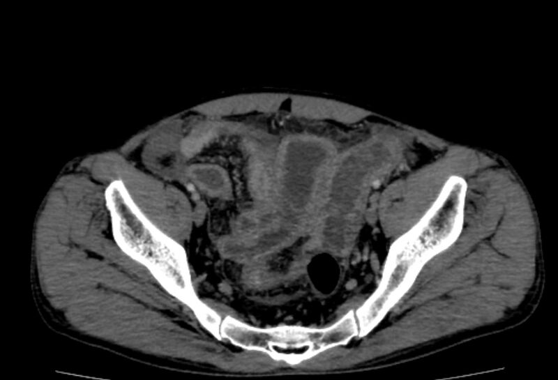 File:Behçet's disease- abdominal vasculitis (Radiopaedia 55955-62570 A 76).jpg