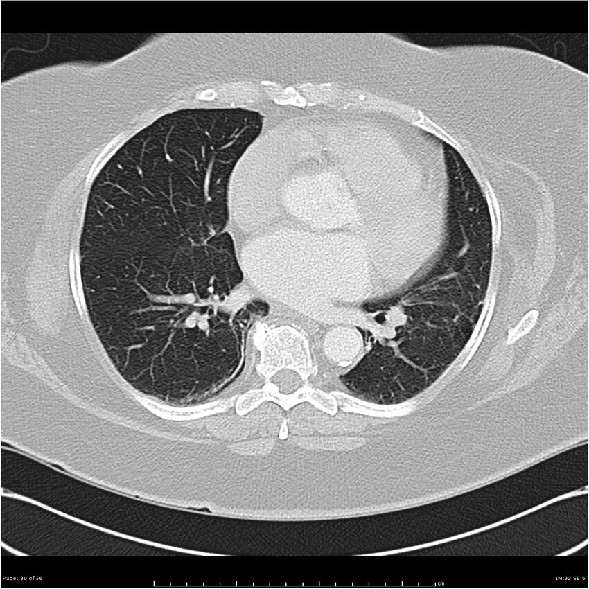 Benign metastasizing leiomyoma (Radiopaedia 26803-26962 Axial lung window 30).jpg