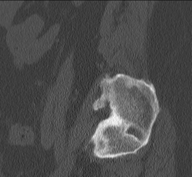 File:Bertolotti syndrome (Radiopaedia 24864-25128 Sagittal bone window 54).jpg