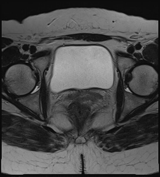 File:Bicornuate, unicollis uterus (Radiopaedia 79468-92593 Axial T2 18).jpg