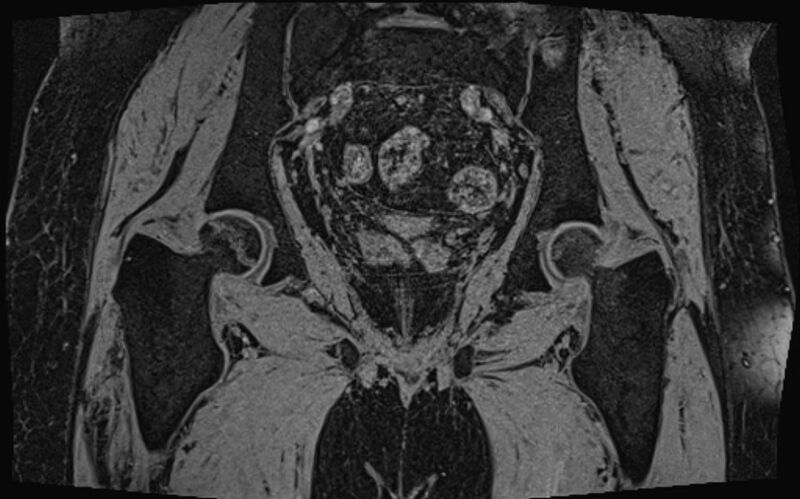 File:Bilateral avascular necrosis of femoral head (Radiopaedia 77116-89078 Coronal T2 we 20).jpg