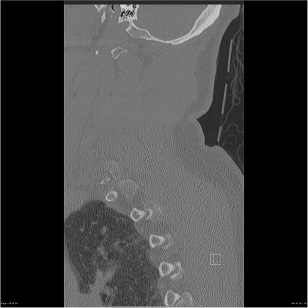 File:Bilateral cervical ribs (Radiopaedia 25868-26017 Sagittal bone window 59).jpg