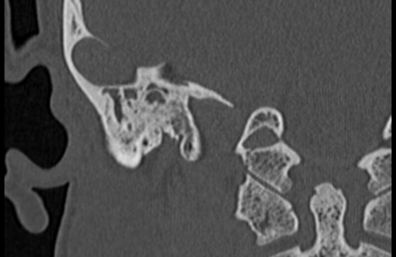 File:Bilateral cholesteatoma (Radiopaedia 54898-61172 Coronal bone window 67).jpg