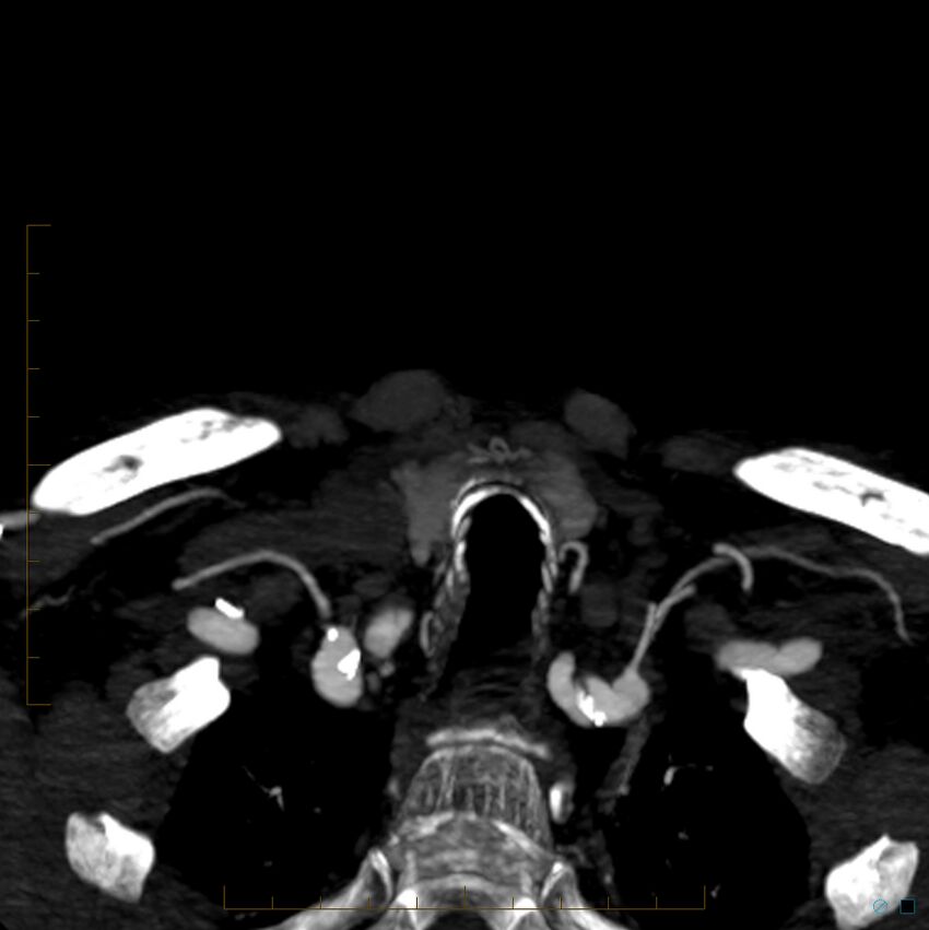 Bilateral chronic common carotid occlusion (Radiopaedia 50849-56362 D 52).jpg