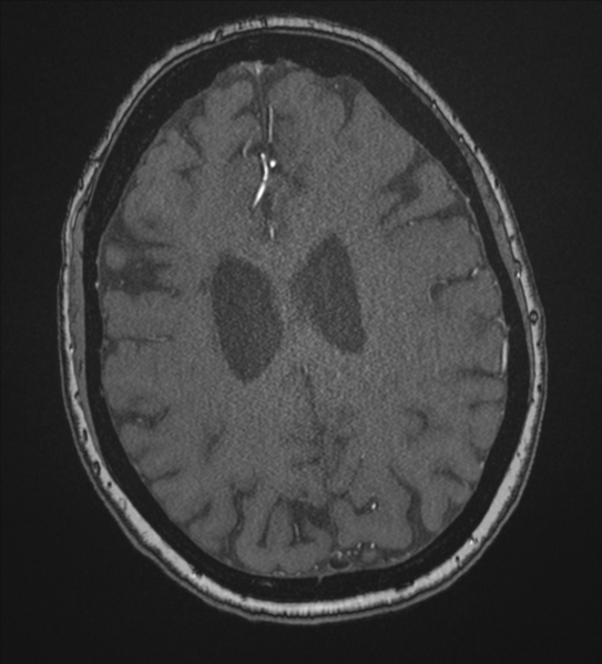 File:Bilateral fetal posterior communicating arteries (Radiopaedia 41286-44102 Axial MRA 159).png