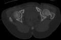 Bilateral mature cystic ovarian teratoma (Radiopaedia 88821-105592 Axial bone window 52).jpg
