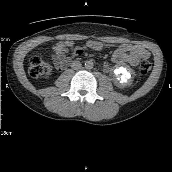 File:Bilateral medullary nephrocalcinosis with ureteric calculi (Radiopaedia 71269-81569 Axial non-contrast 63).jpg