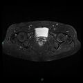 Bilateral ovarian fibroma (Radiopaedia 44568-48293 Axial STIR 23).jpg