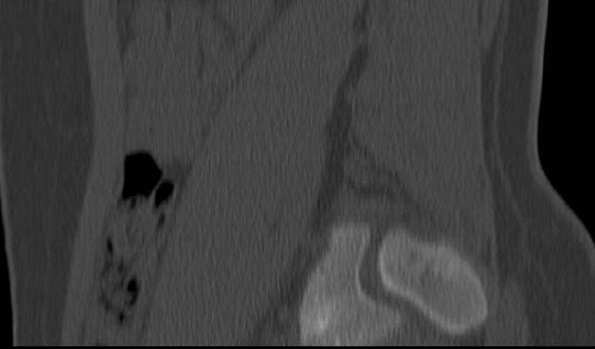 Bilateral pars defect (Radiopaedia 26691-26846 Sagittal bone window 9).jpg